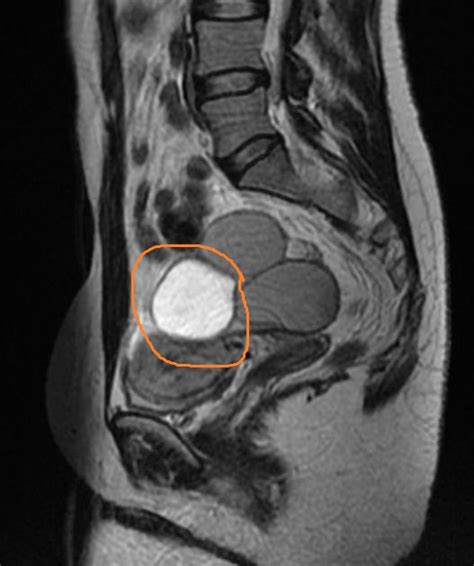 Can an MRI Show Endometriosis: Exploring the Depths of Medical Imaging and Beyond